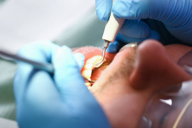 Best Emergency Treatment for Dental Infections or Abscesses in Bonney Lake, WA