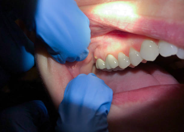 Best Emergency Dental Care for Broken or Chipped Teeth in Bonney Lake, WA